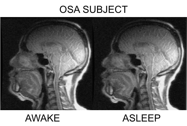 UA-sag-OSA-with-labels.jpg