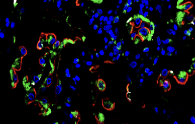 IPF lungs stained for TRIP13 (green), HTII-280 (red) and KRT5 (gray).